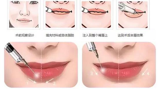 薄唇